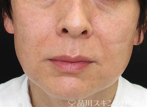 症例NO.58100のBEFORE写真