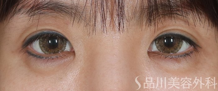 症例NO.72923のBEFORE写真