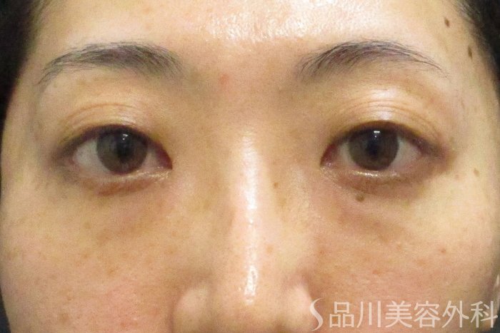 症例NO.69859のBEFORE写真