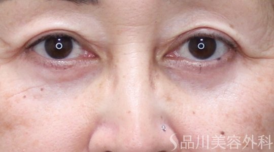 症例NO.73540のAFTER写真