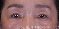 症例NO.74735のAFTER写真