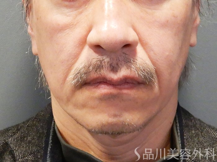 症例NO.70137のBEFORE写真