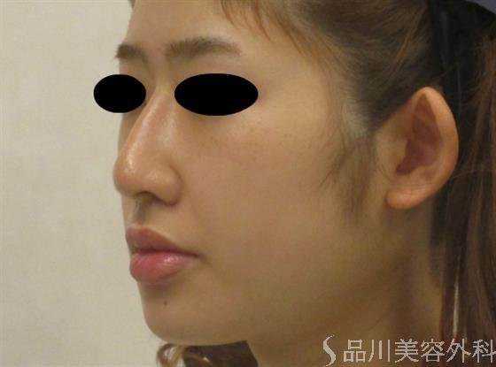 症例NO.48552のAFTER写真