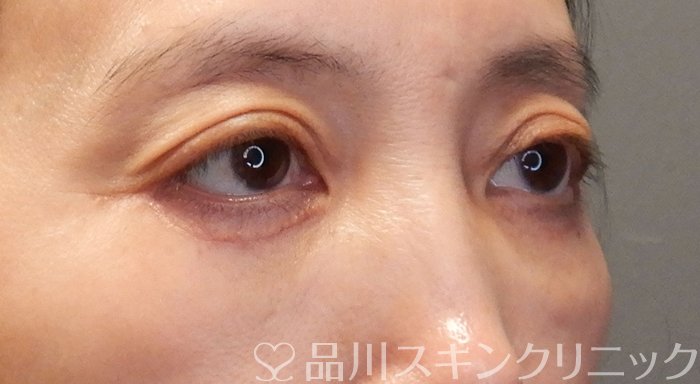 症例NO.70660のAFTER写真