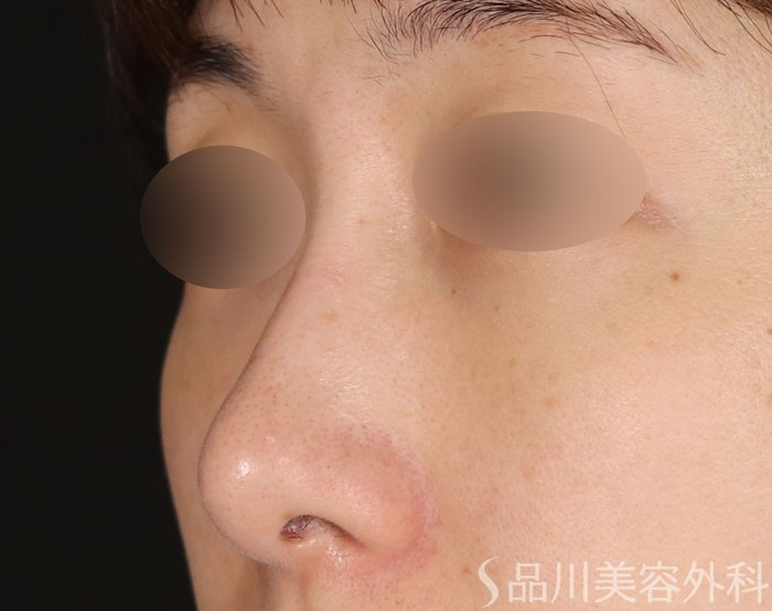 症例NO.72067のBEFORE写真