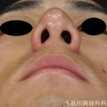 症例NO.72946のAFTER写真