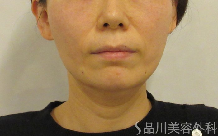 症例NO.73717のAFTER写真