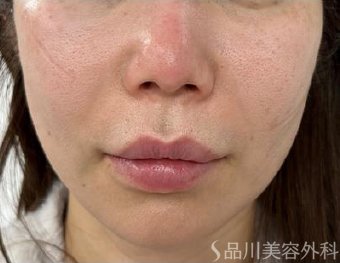 症例NO.70183のAFTER写真