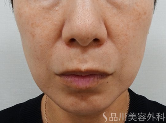 症例NO.73209のBEFORE写真