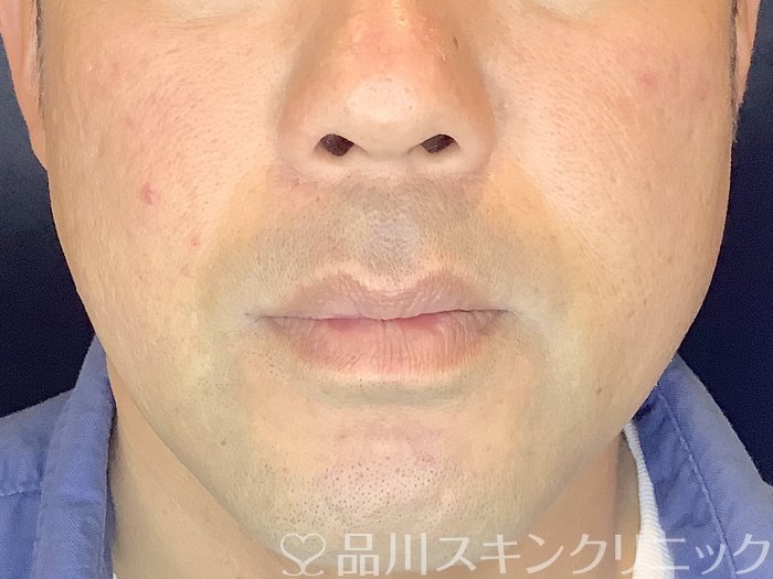 症例NO.65638のAFTER写真