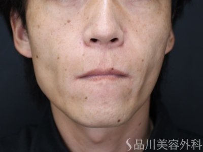 症例NO.75282のAFTER写真