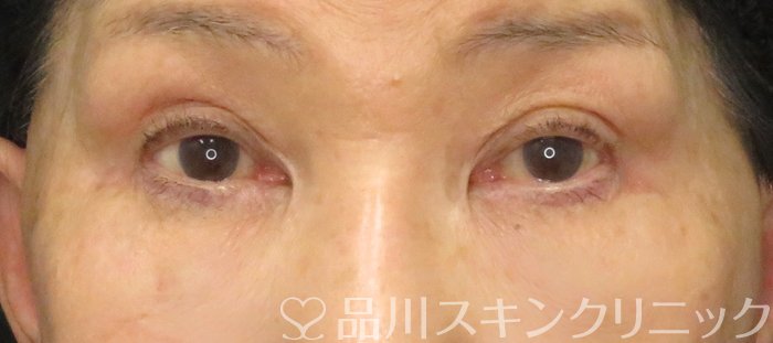 症例NO.73108のAFTER写真