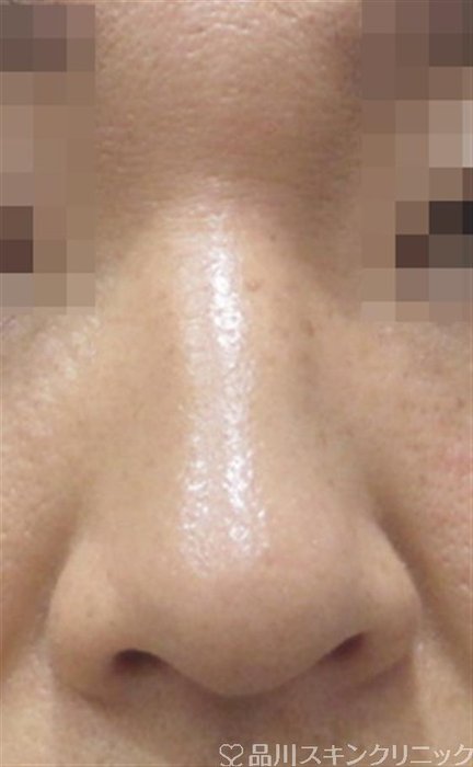 症例NO.35124のBEFORE写真