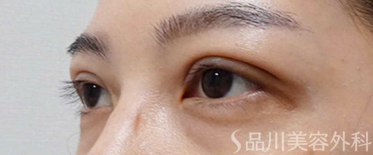 症例NO.65256のAFTER写真