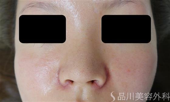 症例NO.38077のAFTER写真