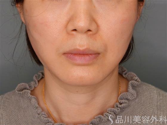 症例NO.53594のAFTER写真