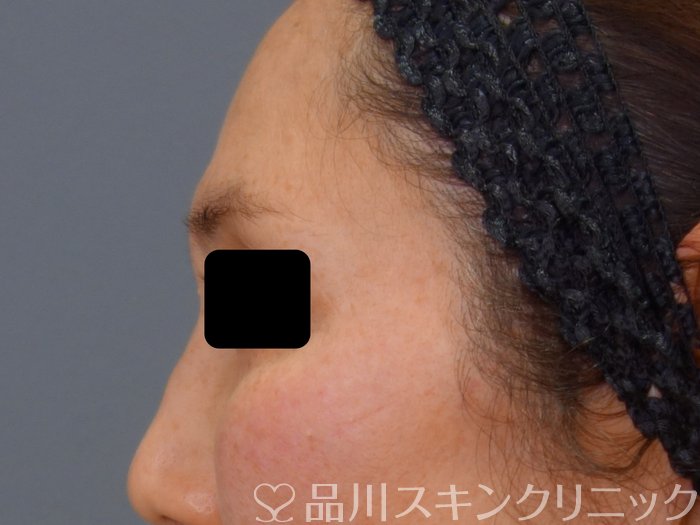 症例NO.73350のBEFORE写真