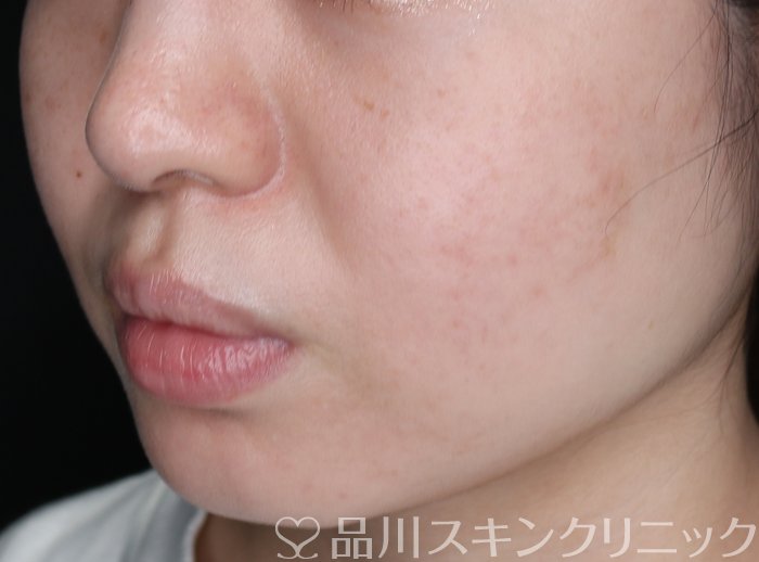 症例NO.74255のAFTER写真