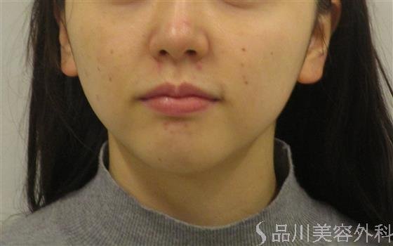 症例NO.58902のBEFORE写真