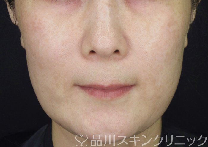 症例NO.62236のAFTER写真