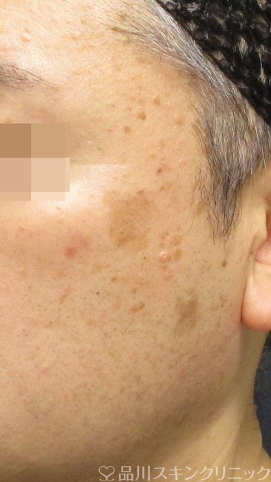症例NO.71182のBEFORE写真