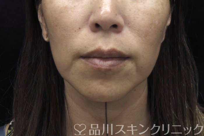 症例NO.74639のBEFORE写真