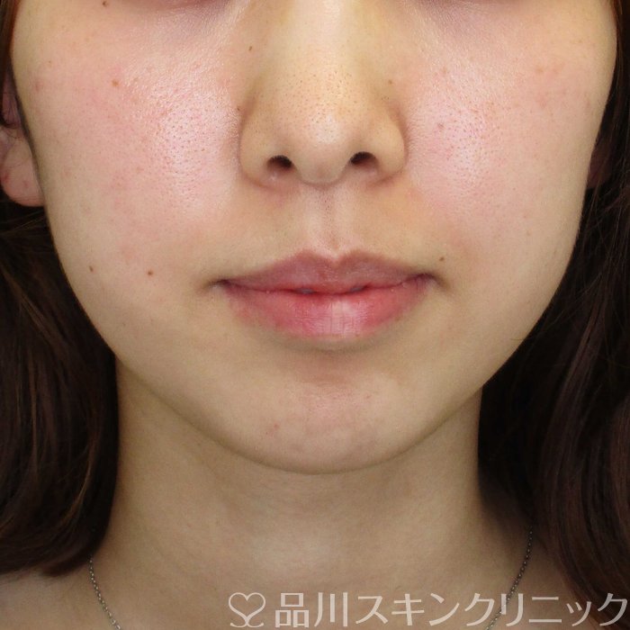 症例NO.65344のBEFORE写真