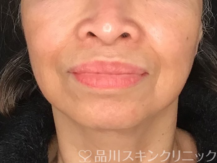 症例NO.65006のBEFORE写真