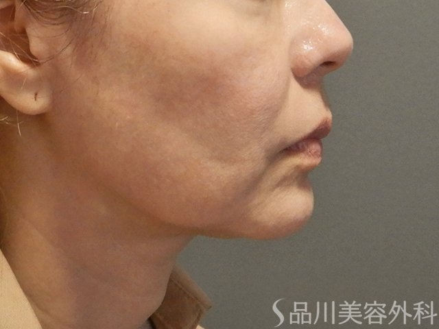 症例NO.71952のBEFORE写真