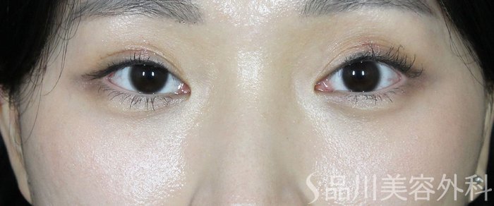 症例NO.63631のAFTER写真