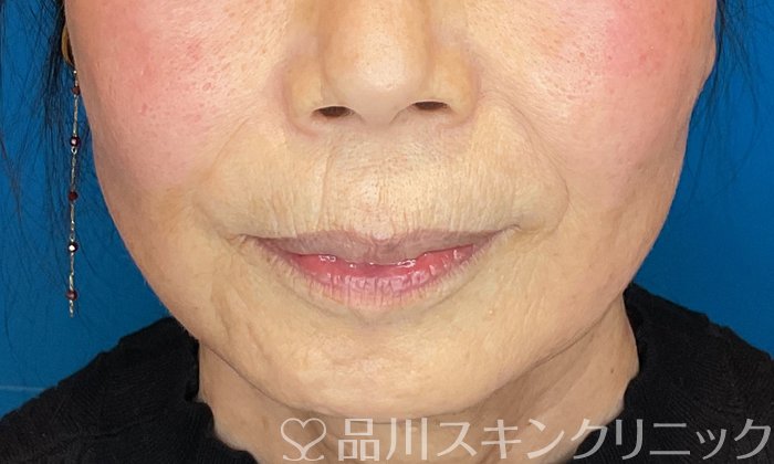 症例NO.72842のAFTER写真