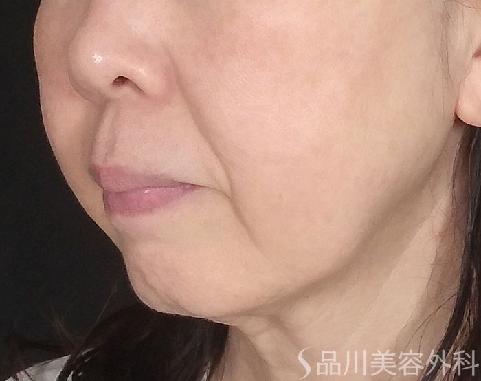 症例NO.65136のBEFORE写真
