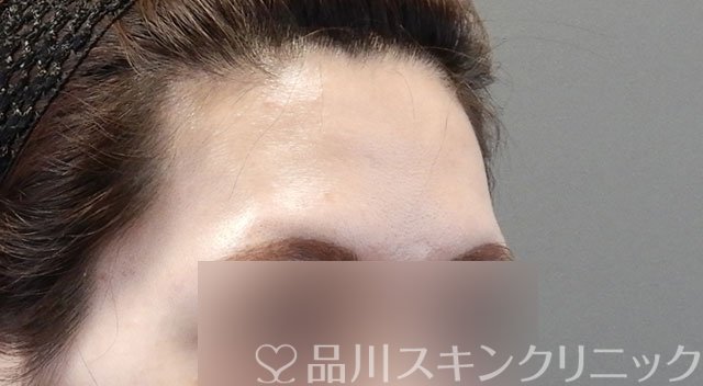 症例NO.63613のBEFORE写真