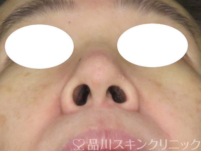 症例NO.65661のBEFORE写真