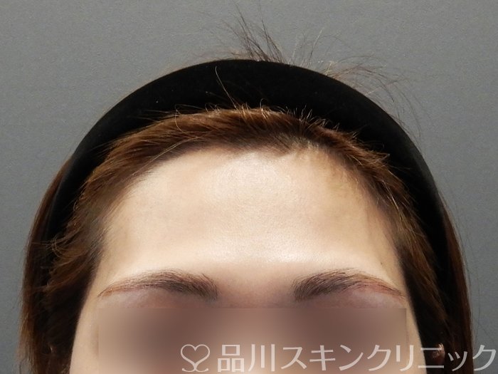 症例NO.73207のBEFORE写真