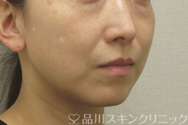 症例NO.73965のBEFORE写真