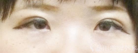 症例NO.33716のAFTER写真