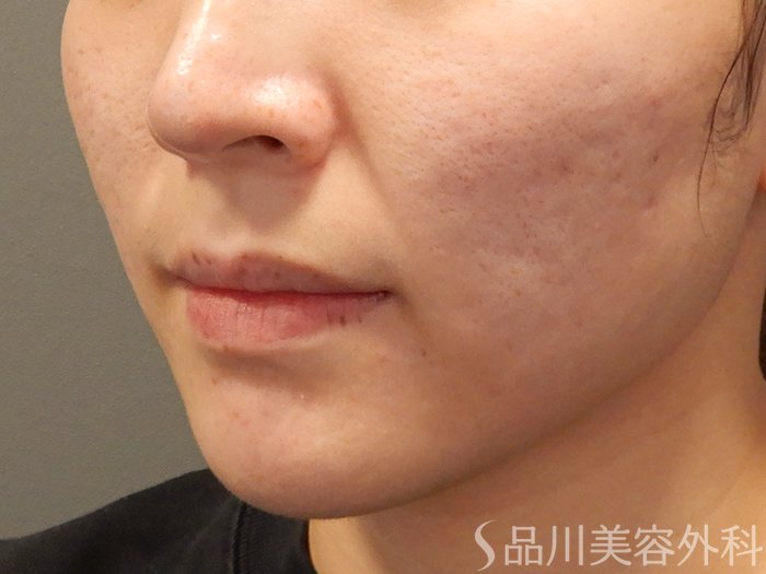 症例NO.69208のBEFORE写真