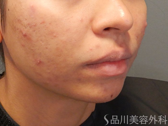 症例NO.70499のBEFORE写真