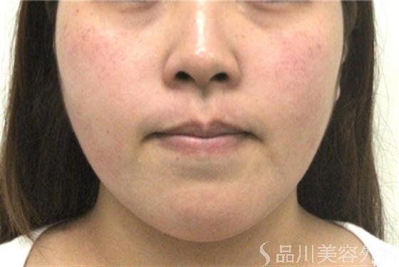 症例NO.19444のBEFORE写真