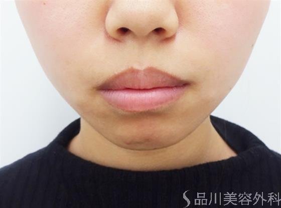 症例NO.40864のBEFORE写真