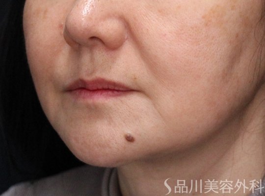 症例NO.74526のBEFORE写真