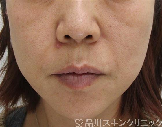 症例NO.41093のAFTER写真