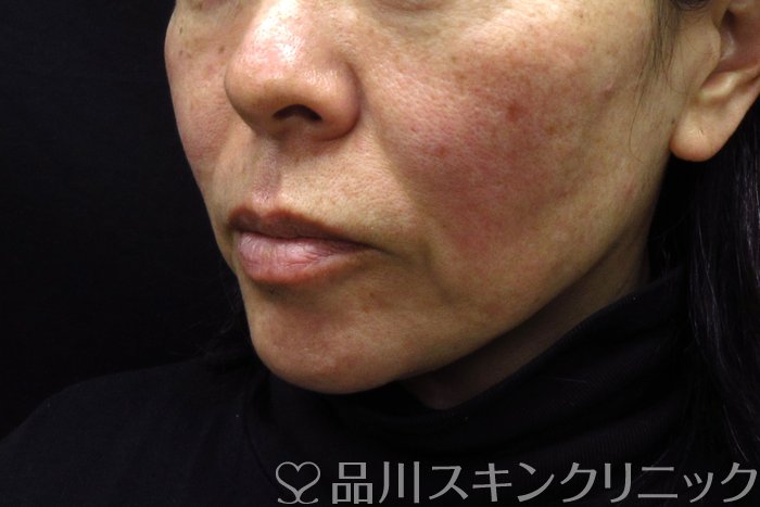 症例NO.74618のBEFORE写真