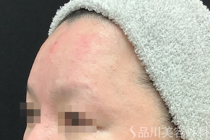 症例NO.67802のAFTER写真