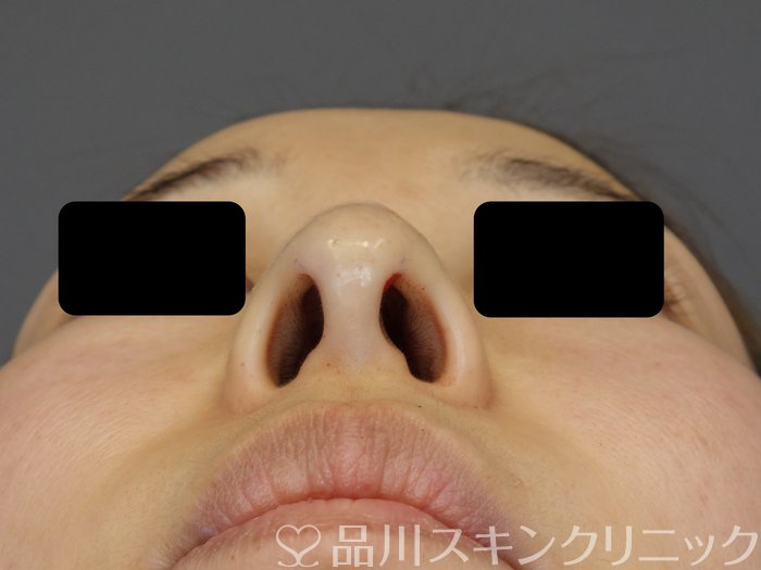 症例NO.73745のAFTER写真