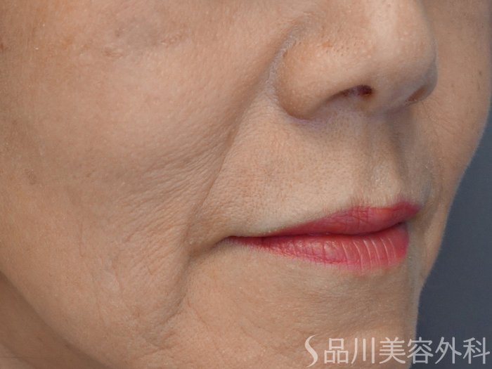 症例NO.67650のBEFORE写真