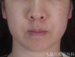 症例NO.73776のBEFORE写真