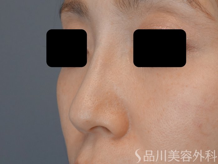 症例NO.72407のBEFORE写真