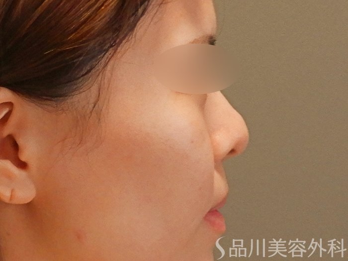 症例NO.67617のBEFORE写真